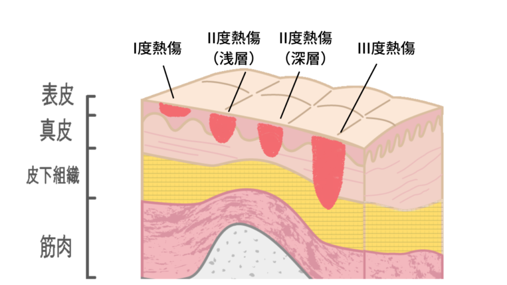 水ぶくれやヒリヒリ痛みも やけど 熱傷 の薬や処置について解説 ひまわり医院 内科 皮膚科