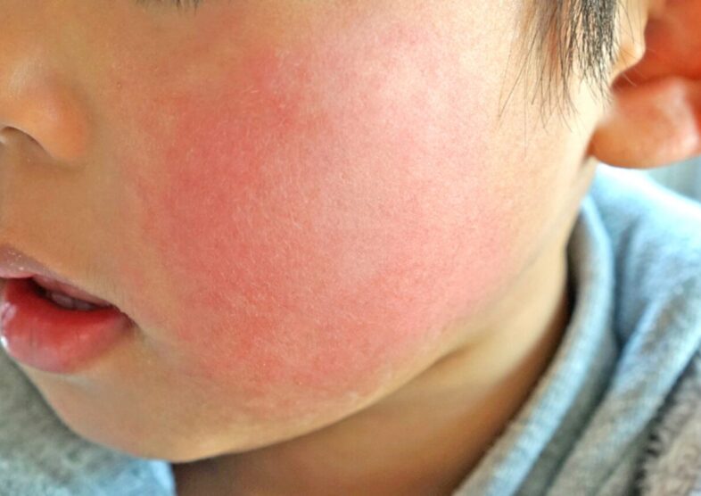 ライム病の発疹はどれくらいの頻度で起こりますか?