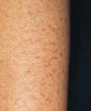 乾燥肌 皮脂欠乏性湿疹 について解説 原因 症状 普段のケア方法 ひまわり医院 内科 皮膚科