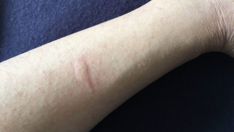 慢性自然蕁麻疹とは何ですか?