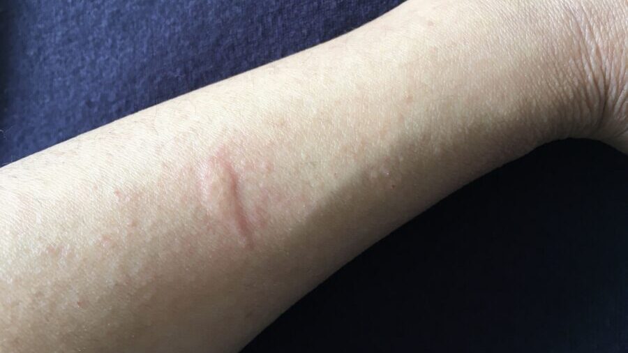 蕁麻疹の応急処置