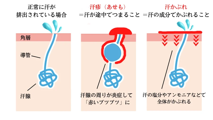 汗疹 あせも や汗かぶれについて解説 原因 症状 治し方 ひまわり医院 内科 皮膚科