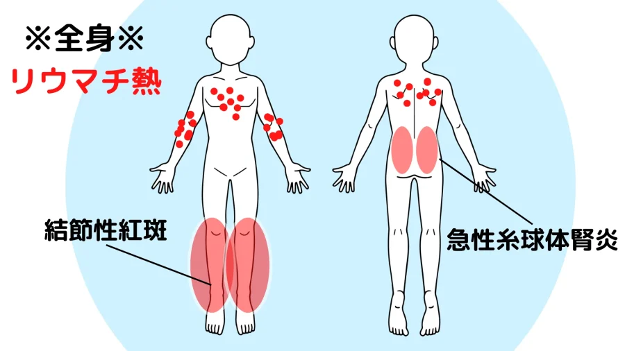 溶連菌感染症の合併症の一覧