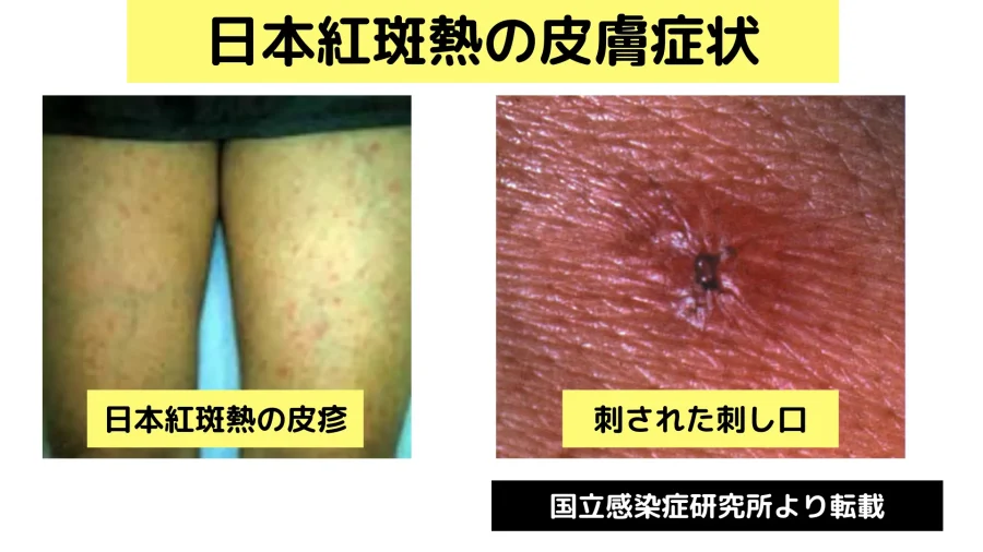 日本紅斑熱の皮膚症状と刺された刺し口。国立感染症研究所より転載。