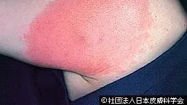 ライム病の写真。日本皮膚科学会より転載。
