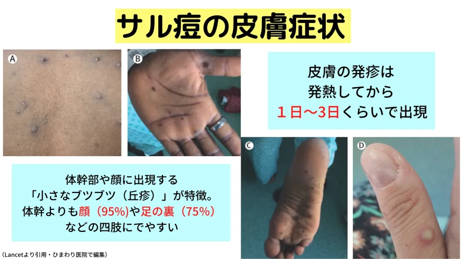 サル痘の皮膚症状の特徴と具体的な画像・写真。
