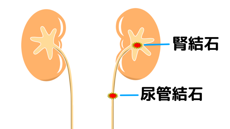 尿管結石（尿路結石）の原因や症状・予防法について解説 | ひまわり医院（内科・皮膚科）