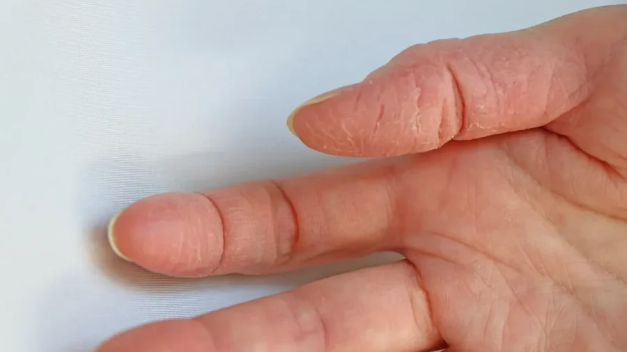 湿疹はどのようにして起こるのでしょうか？