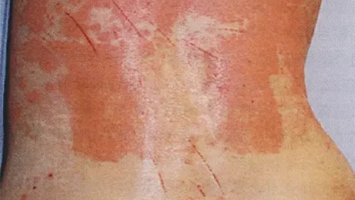 誰が多形光噴出の危険にさらされていますか?