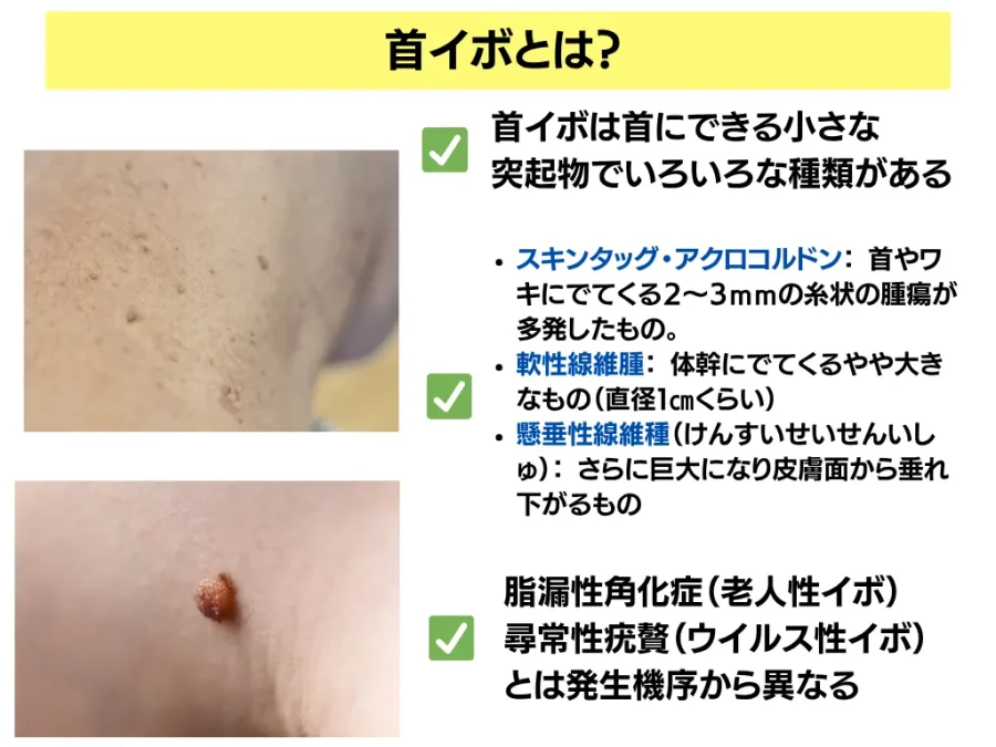 首のイボとり 施術動画つき首イボ、実は簡単に取れます