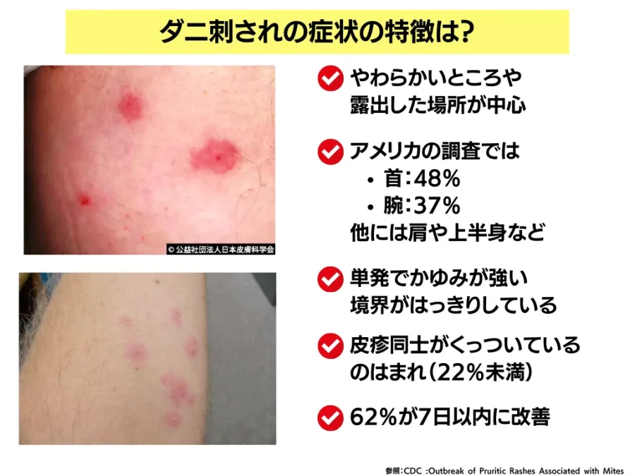 ダニ刺されの特徴について解説【症状・薬・治し方やダニ対策 