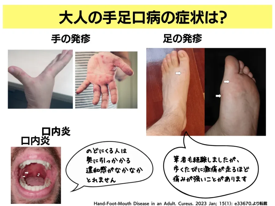 大人の手足口病の特徴について【症状・治療・発疹の写真も掲載
