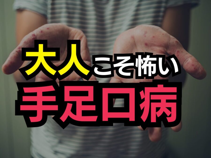 大人の手足口病の特徴について【症状・治療・発疹の写真も掲載